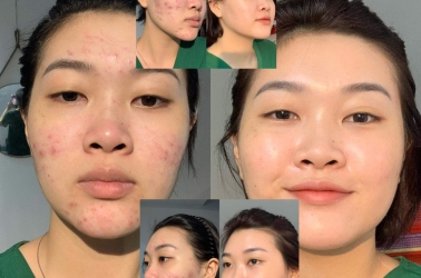 Trị Mụn Chuyên Sâu