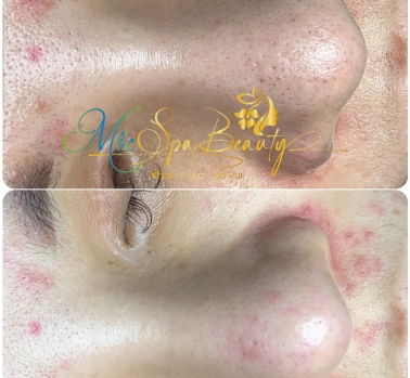  Điều Trị Mụn
