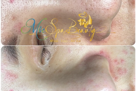 Điều Trị Mụn