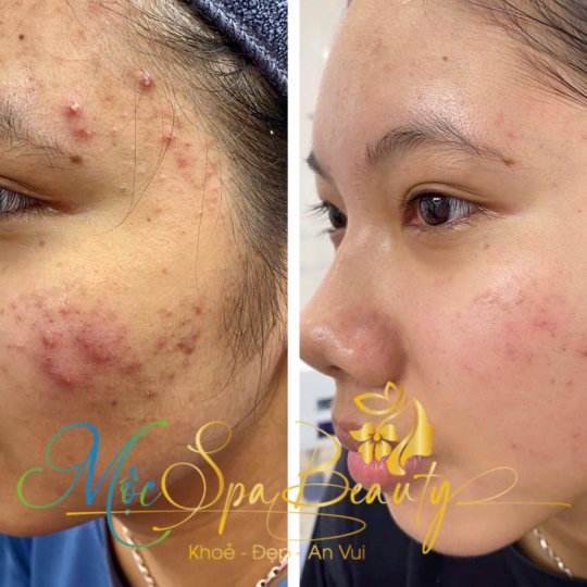 Trị Mụn Chuyên Sâu