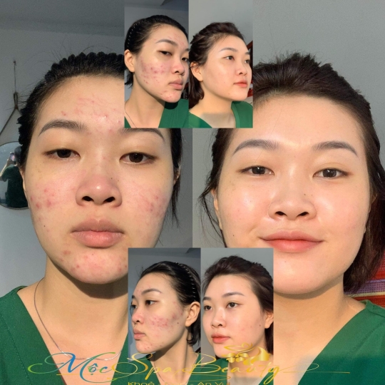Trị Mụn Chuyên Sâu